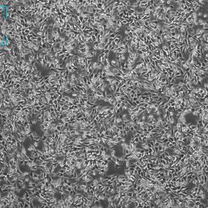 人脑星形胶质母细胞瘤