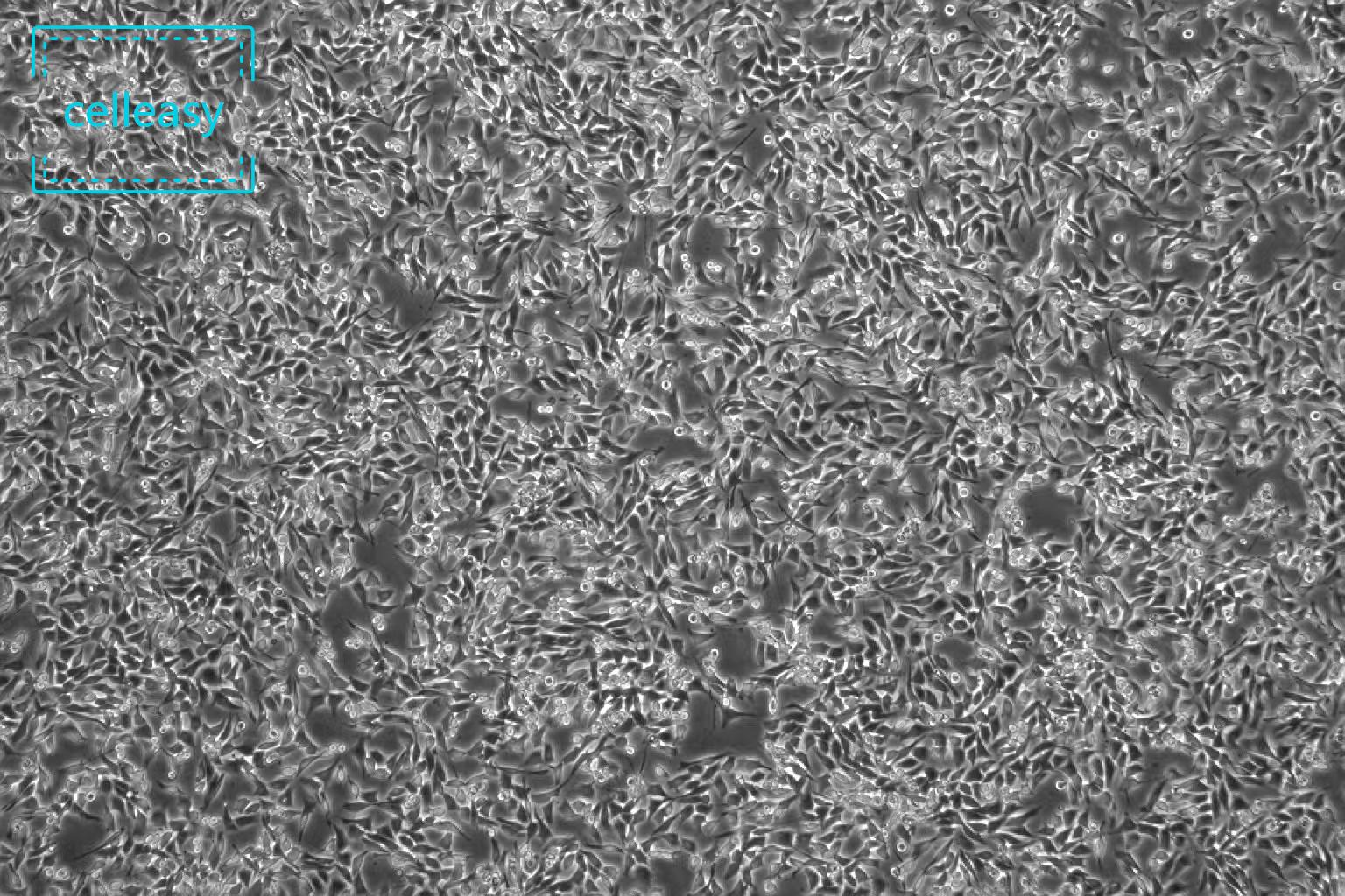 人脑星形胶质母细胞瘤